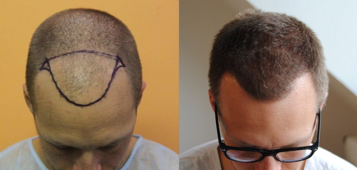 Alopecia, hair growth, hair transplant cost,Hair Transplant Reviews, Hair  Transplant Photos, Hair Transplant Blog, Hair Transplant Forum  International, Hair Transplant Turkey, hair transplant forum - Blog View -  Dr Bisanga Result 2485