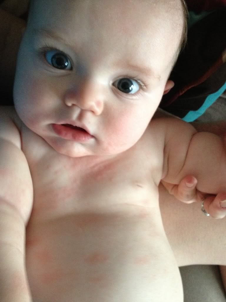 Baby Is Definitely Allergic To Pic Babycenter